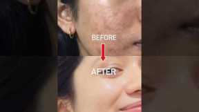 1 PRODUCT Changed ACNE TO CLEAR SKIN JOURNEY🤍🥺With in 2 month#acne