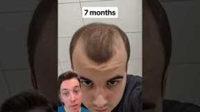 Calling BS on “Just Minoxidil”?