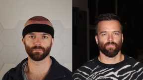 My 6 Month Hair Transplant Update