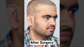 Nine Months Hair Transplant Result | Latest Fue Technique #shorts #viral #hair transplant