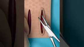 Buried Stitch Hacks 😷 #goodtoknow #suturing #lifehacks #vet #medicine #surgeonlife #funfacts