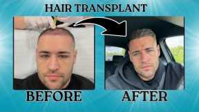 My Second Hair Transplant | 5 month Update