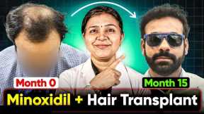 Minoxidil + Hair Growth Time Lapse | Best Hair Transplant Results in India | Hair Growth