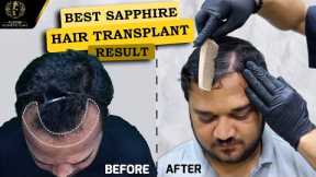 Best Sapphire FUE Hair Transplant Results (Time Lapse) Dr.Pranil More