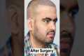 Nine Months Hair Transplant Result |