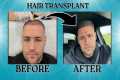 My Second Hair Transplant | 5 month