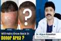 Donor Area Recovery: Will Hair Regrow 