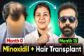 Minoxidil + Hair Growth Time Lapse |