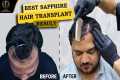 Best Sapphire FUE Hair Transplant