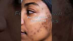 Pharmacy creams for acne marks (more details on  description box ) #facedecor #skincare #shorts
