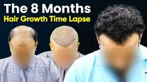 Hair Transplant Time Lapse - Hair Transplant Before & After | Hair Transplant Results and Hair Style