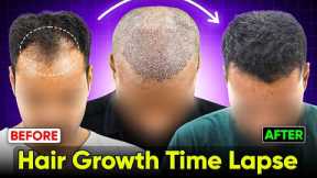 Hair Growth Time Lapse - 5 Months Hair Transplant Before & After | Hair Transplant Results #hair