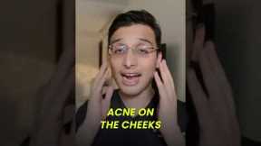 Getting acne on specific areas of the face?? || Dr Ankur Sarin ||