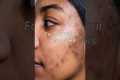 Pharmacy creams for acne marks (more