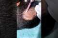 Alopecia Areata Treatment For Hair