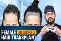 Female Hair Transplant Surgery