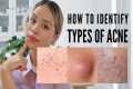 How to treat EVERY type of acne (With 