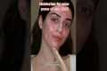 Moisturizers for acne prone skin