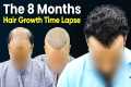 Hair Transplant Time Lapse - Hair