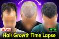 Hair Growth Time Lapse - 5 Months