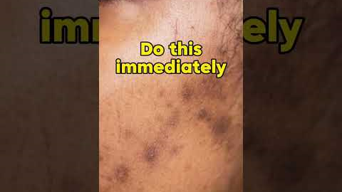 2 steps to reduce acne scars