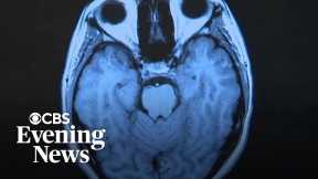 Researcher says Long COVID causing great deal of suffering