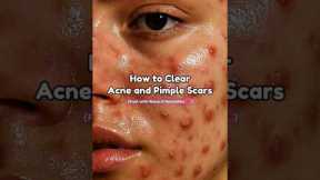 How to Clear Acne & Pimple marks #shorts #888 #beauty #fyp #acne #kpop #skincare #youtubeshorts