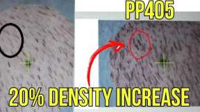 PP405 HAIR LOSS BREAKTHROUGH? PELAGE GROWS HAIR 20% IN 4 WEEKS!