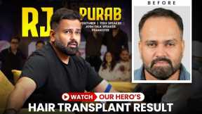 RJ Purab Hair Transplant Results | Amazing Hair Transformation in Hairfree & Hairgrow Clinic