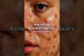How to Clear Acne & Pimple marks