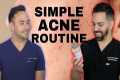 SIMPLE ACNE ROUTINE FROM A