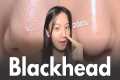How to really remove blackheads at