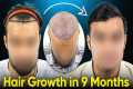 Hair Growth Results (9 Months Before