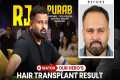 RJ Purab Hair Transplant Results |
