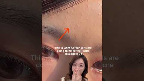 How Korean girls remove acne/tiny pimples/whiteheads #shorts