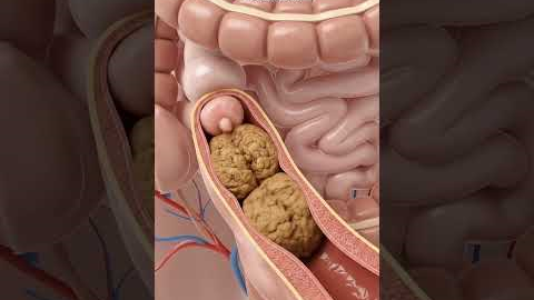 Illustration of Constipation Moving | Gut Health | Anatomy Art USA