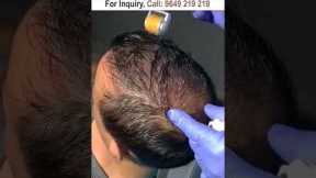 Dermaroller for hair growth #dermaroller #dermarollerforhairgrowth #hairgrowth #dermarollerforhair