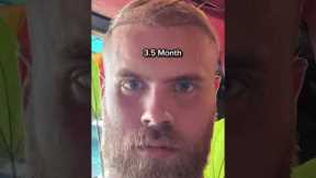 Transformation in the First 4 Months After Hair Transplant