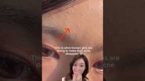 How Korean girls remove acne/tiny pimples/whiteheads #shorts