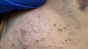 Aggressive Blackhead Extraction ASMR — Pimple Popping & Facial Care
