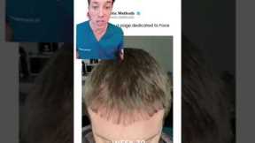 Hair Transplant Recovery Timeline