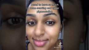 How I got rid of my acne scars and hyper pigmentation!!
