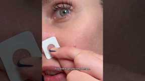 How An Esthetician Gets Rid Of A Pimple In 1 Day!! Zitsticka Killa Patch #zitsticka #acne #skincare