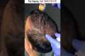 Dermaroller for hair growth