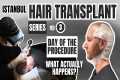 Watch My Hair Transplant Procedure in 