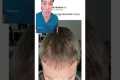 Hair Transplant Recovery Timeline