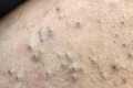 Intense Pore Cleaning Techniques -