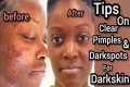 Clear pimples and darkspots With My