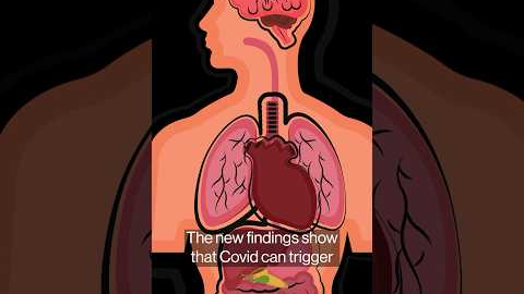 Long Covid Study Links Lingering Virus With Bowel-to-Brain Havoc