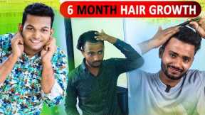 Hair Transplant 6 Month Results! Hair Growth in India 2025